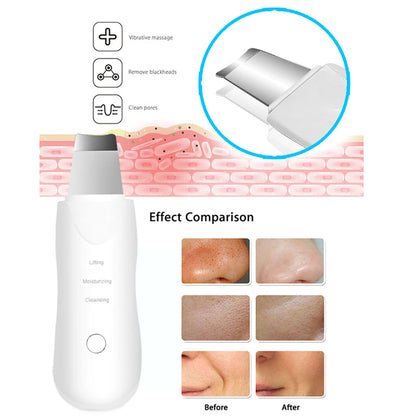 Espátula Facial Ultrassônica-Remove Cravos e Limpa Poros Profundamente